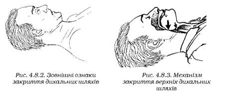 зовнішні ознаки закриття дихальних шляхів