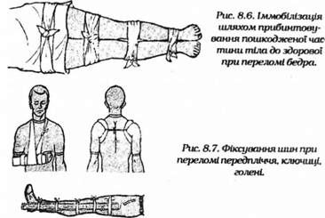 іммобілізація шляхом прибинтовування пошкодженої частини тіла 