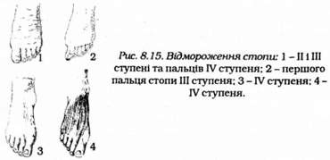 відмороження стопи